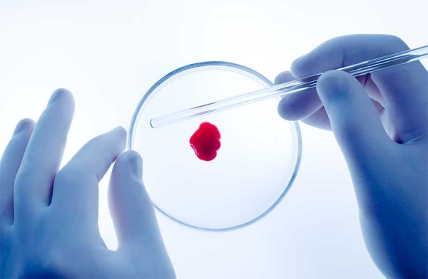 Epatite C, l&#039;importanza della diagnosi